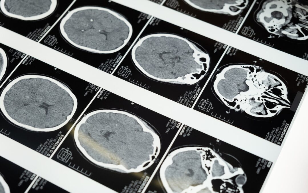 CRO especializada en oncología para ensayos clínicos de gliomas y glioblastomas en los Estados Unidos